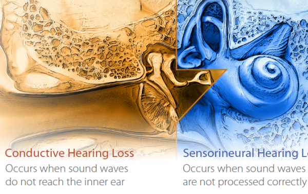 Mixed-Hearing-Loss-2.png